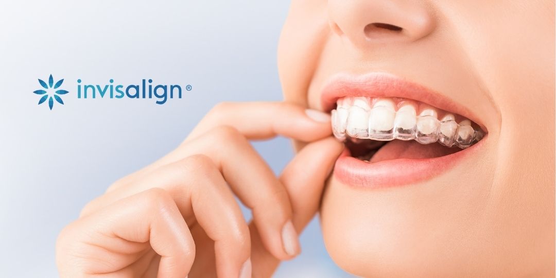 Orthodontics -Aligner Therapy